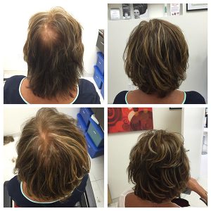 Chuck Alfieri Medical Hair Loss Gallery